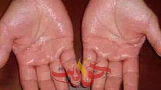 هذه هى اسباب تعرق اليدين .. تعرف على الحلول