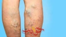 ما هى أعراض دوالي الساقين وأسبابها