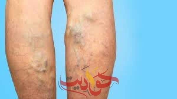 ما هى أعراض دوالي الساقين وأسبابها