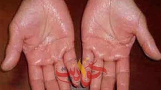 تعرف على .. هذه الوصفات والنصائح للتخلص من تعرق اليدين والقدمين