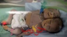 حالة نادرة ..  ولادة توأم فى سوهاج “أحدهما برأسين”