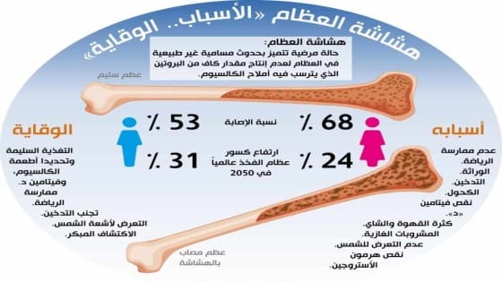 هشاشة العظام يصيب أكثر من 200 مليون انسان بالعالم
