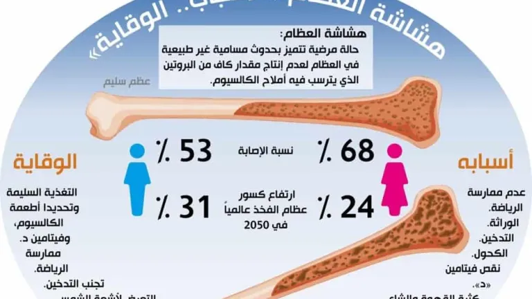 هشاشة العظام يصيب أكثر من 200 مليون انسان بالعالم .. دراسة مصرية : ينتشر بمحافظات الوجه البحري عن القبلي