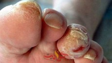 7 خطوات يجب عليك اتباعهم للعناية بالقدم السكرى