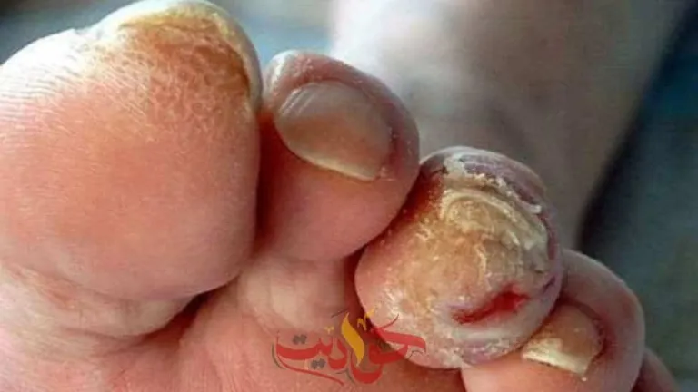 7 خطوات يجب عليك اتباعهم للعناية بالقدم السكرى