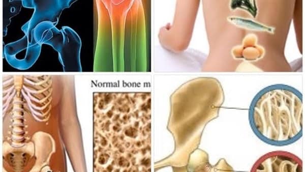 هشاشة العظام