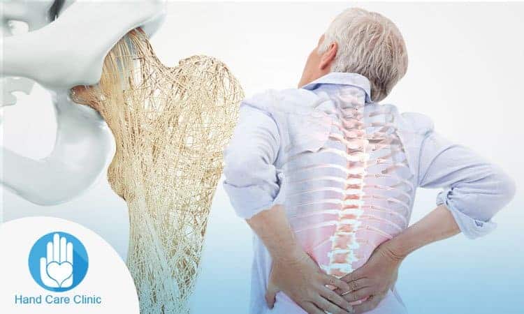 هشاشة العظام