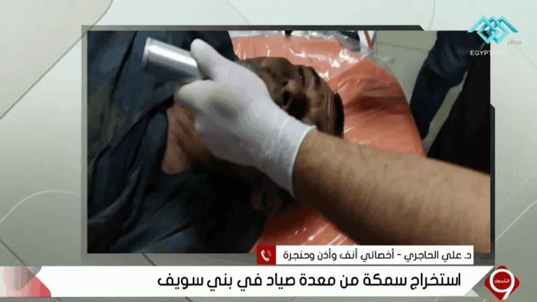 شاهد بالفيديو .. استخراج سمكة «حية» من القصبة الهوائية لصياد بني سويف