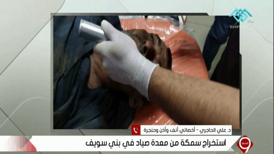 استخراج سمكة حية من القصبة الهوائية لصياد بني سويف