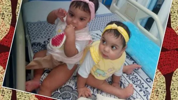 بالصور .. مستشفى الدمرداش ينجح فى فصل توأم ملتصق