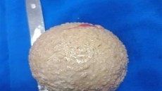 صحة الوادي الجديد: استخراج حصوة بحجم كرة التنس من مثانة مريض