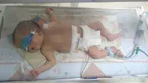 جراحة نادرة.. استئصال جنين مكتمل من بطن طفلة عمرها أسبوع في أسيوط