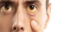 هذه هى أسباب اصفرار العين