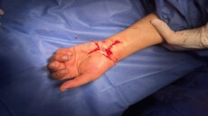 للمرة الثانية في تاريخه .. قصر العيني يحقق معجزة طبية بزراعة يد مبتورة