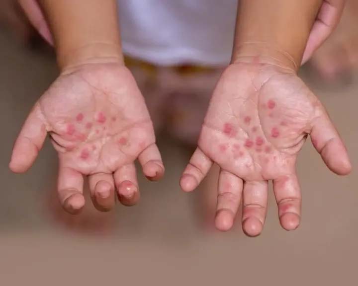 فيروس غامض يطرق أبواب مدارس الجيزة .. ما حقيقته؟ 1 فيروس غامض يطرق أبواب مدارس الجيزة .. ما حقيقته؟